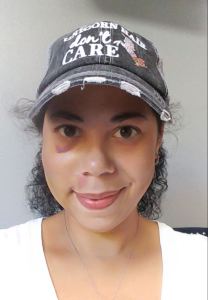 The first selfie I published after the accident.